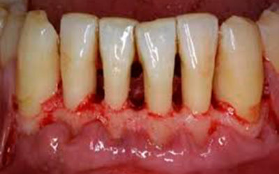 Periodontitis