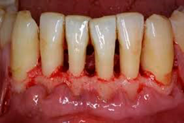 Periodontitis