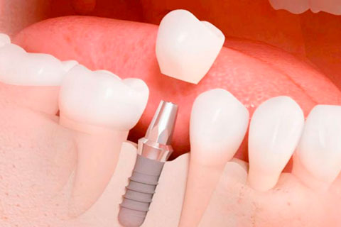 Implantes Dentales Precio