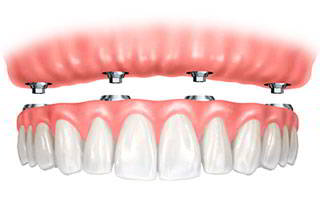Prótesis Dental fija sobre Implantes Dentales protesis dental fija sobre implantes dentales