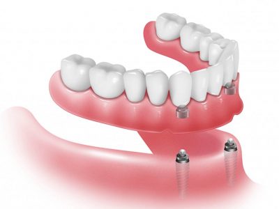Prótesis Dental Soportada con Implantes Dentales
