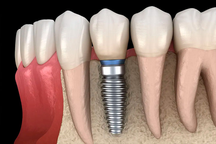 Qué es la Osteointegración