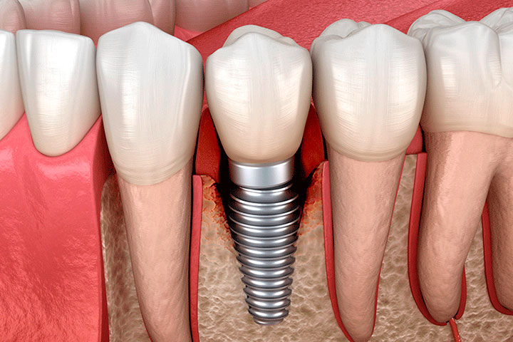 Que es la Periimplantitis