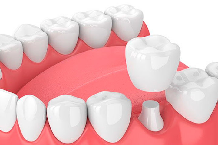 Qué es una Corona Dental