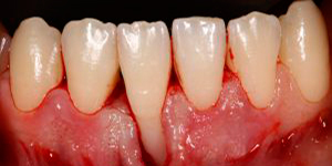 Recesión-gingival0