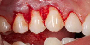 Recesión-gingival00