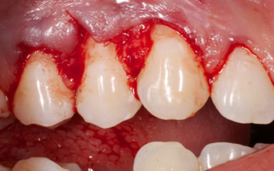 Recesión Gingival