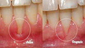 Recesión-gingival000