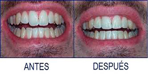 Recontorneado-estético-dental1