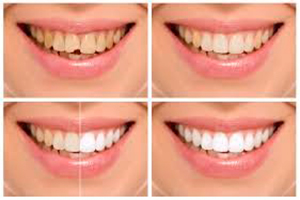 Recontorneado Estético Dental