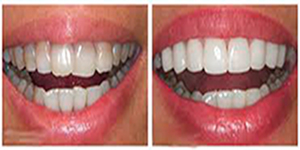 Recontorneado-estético-dental4
