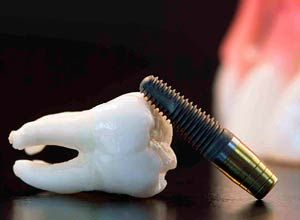 ¿Qué riesgos representan los Implantes Dentales de baja calidad?