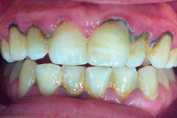 índice sin embargo Ponte de pie en su lugar Limpieza Dental | Estética e Implantología Dental | Dr. Ricardo Molina