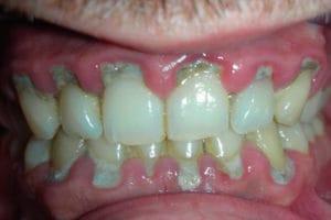 Tartrectomía Estética e Implantología Dental Dr. Ricardo Molina