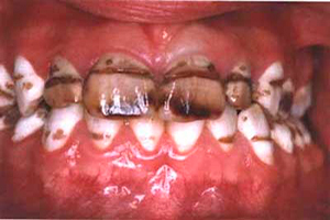 Terapia de Fluoruro