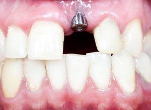 ¿Qué necesito saber antes de ponerme un Implante Dental?