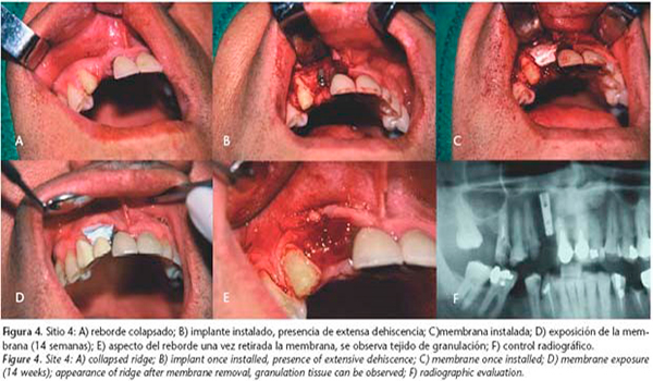Técnica-de-regeneración-ósea-guiada2