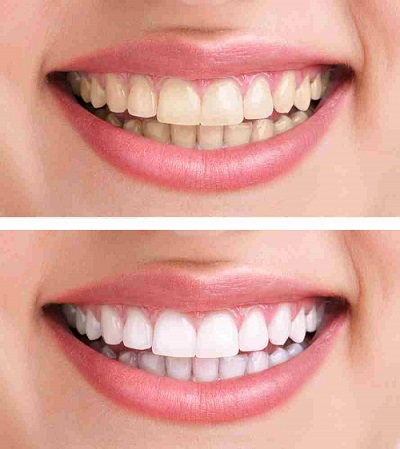 Blanqueamiento Dental - Antes y Después