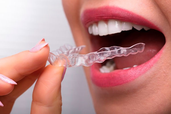 Blanqueamiento Dental con Férulas
