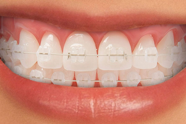 Brackets de Zafiro