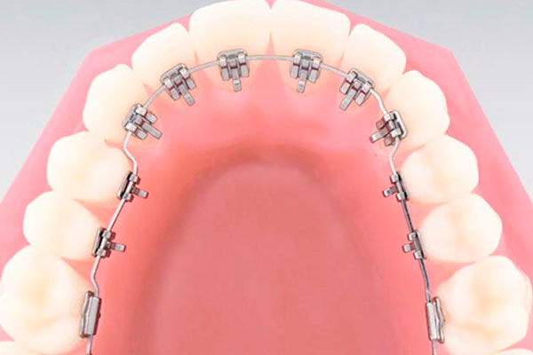 Brackets Linguales