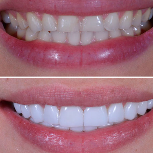 Carillas Dentales - Antes y Después