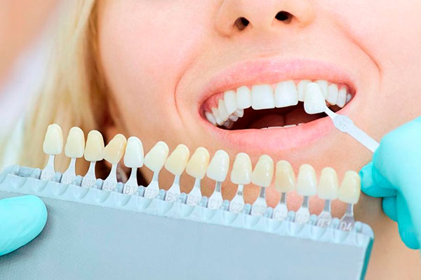 Carillas Dentales Precio
