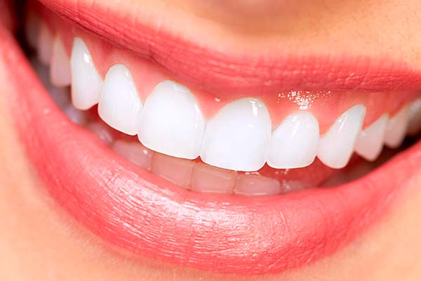 Carillas Dentales Ventajas