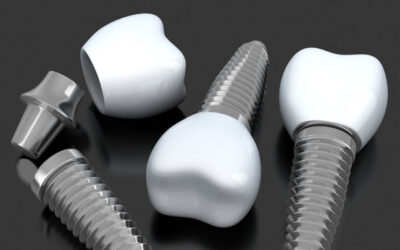 ¿Comó son los Implantes Dentales?