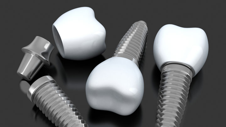Comó son los implantes dentales