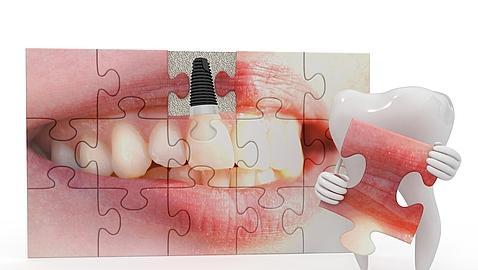 Union de implantes dentales