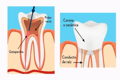 endodoncia5