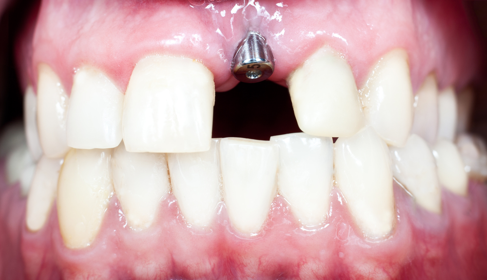 dental implant 