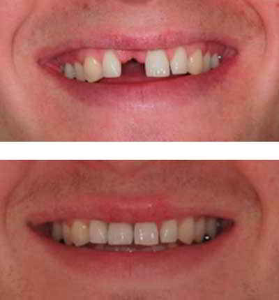 Implantes Dentales Antes y Después Implantes Dentales Antes y Después