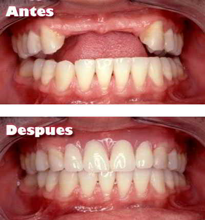 Implantes Dentales Ejemplo Implantes Dentales Ejemplo