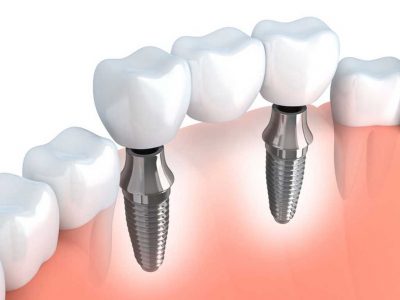 Implantes Dentales All on Four