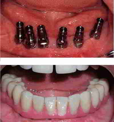 Prótesis Fija sobre Implantes Dentales Prótesis Fija sobre Implantes Dentales