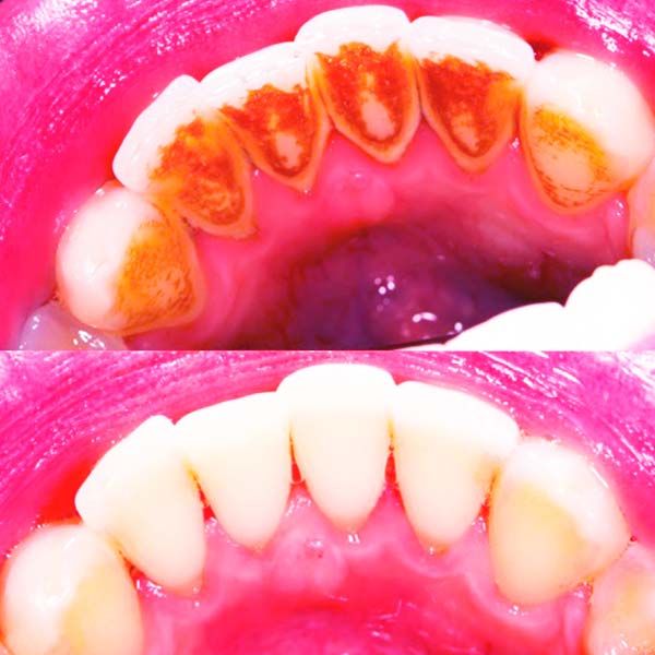 Limpieza Dental Antes y Después