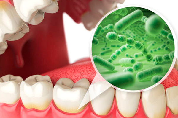 Limpieza Dental Placa Bacteriana
