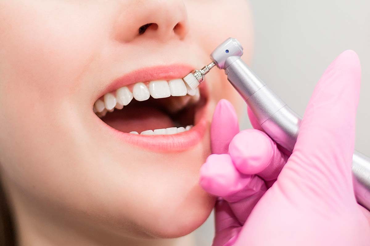 Limpieza Dental
