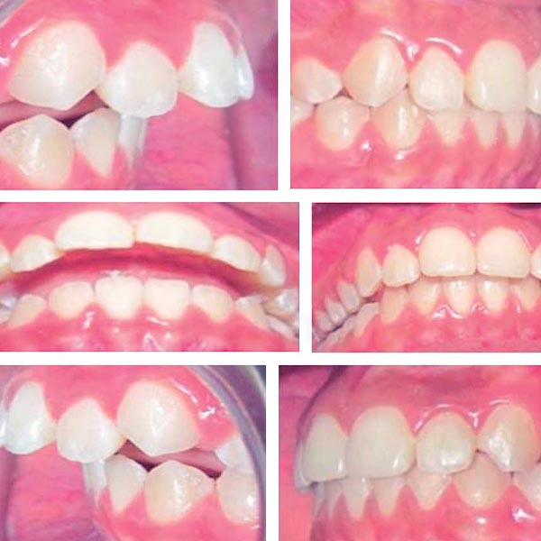 Ortodoncia Estética