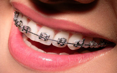 Estética Dental