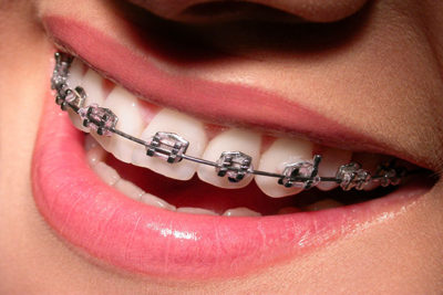 ortodoncia-frenos-dentales