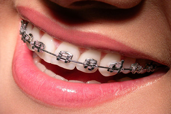 Estética Dental