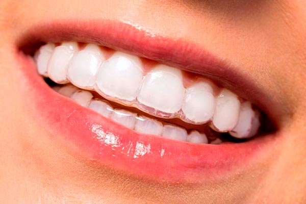 Ortodoncia Invisible Invisalign