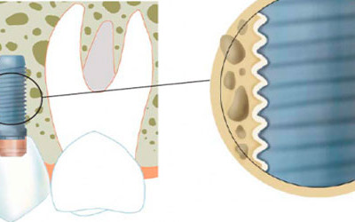 Osteointegración
