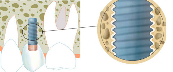 Osteointegracion