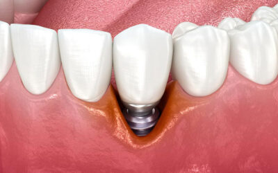Lo que debes saber sobre Implantes Dentales