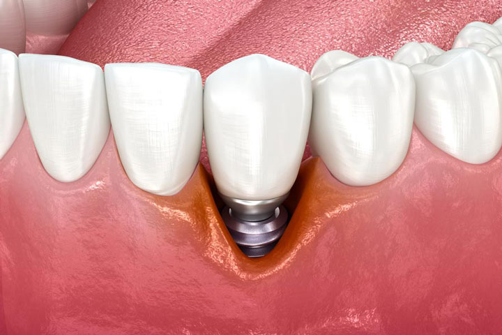 Lo que debes saber sobre Implantes Dentales