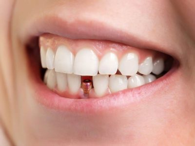 Persona con Implante Dental